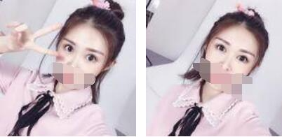 沒有了眼袋困擾，身體和心態(tài)都年輕了十歲