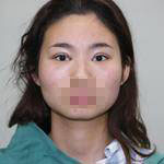 做了雙眼皮手術，讓我的眼睛更有神