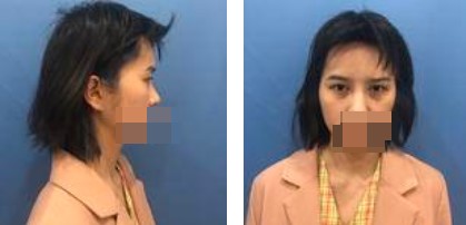 手術(shù)前的照片 手術(shù)前的照片