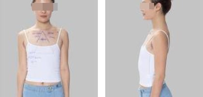 樸正淳假體隆胸案例分享 樸正淳假體隆胸案例分享