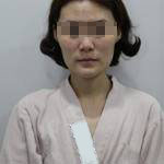 做完自體脂肪豐面頰后，我的面部比例更加完美了呢