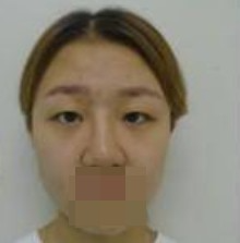 做了全切雙眼皮不僅外表變美了，內(nèi)心也更加自信了