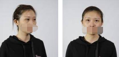 沒有了眼袋困擾，身體和心態(tài)都年輕了十歲