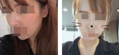 面部吸脂讓你做一個(gè)更受歡迎的精致“小臉”的女人