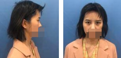 做了切開雙眼皮手術(shù)，才發(fā)現(xiàn)自己原來可以這么美！