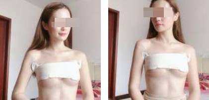 樸正淳假體隆胸案例分享 樸正淳假體隆胸案例分享