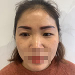 雙眼皮修復(fù)給我重新帶來(lái)了自信和面對(duì)生活的勇氣