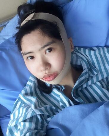 下頜角手術(shù)第四天 下頜角手術(shù)第四天