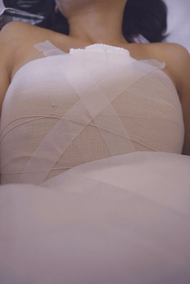 邯鄲凱潤婷整形醫(yī)生馬戰(zhàn)勝做自體脂肪隆胸怎么樣？ 附馬戰(zhàn)勝自體脂肪隆胸案例