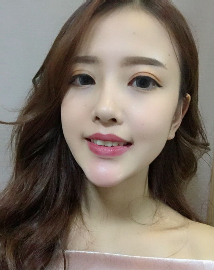 成都漢密爾頓美容醫(yī)院做牙齒矯正怎么樣？成都漢密爾頓牙齒矯正案例