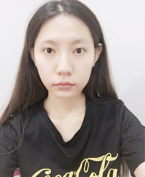  濟(jì)南安美醫(yī)療整形醫(yī)生李思思做下頜角整形怎么樣？李思思下頜角整形案例