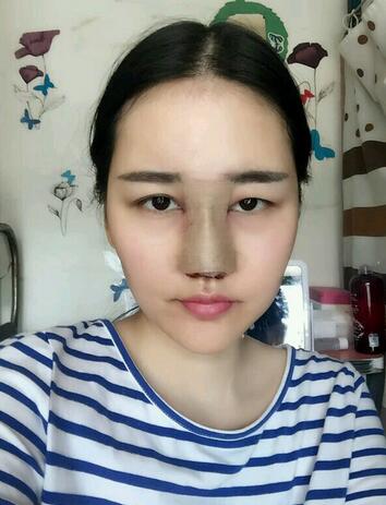 漢中韓美整形醫(yī)生常雙模假體隆鼻+耳軟骨墊鼻尖真實案例效果圖