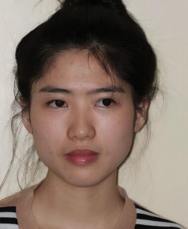 術(shù)前: 術(shù)前: