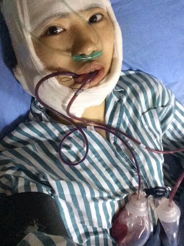 下頜角手術(shù)當(dāng)天 下頜角手術(shù)當(dāng)天