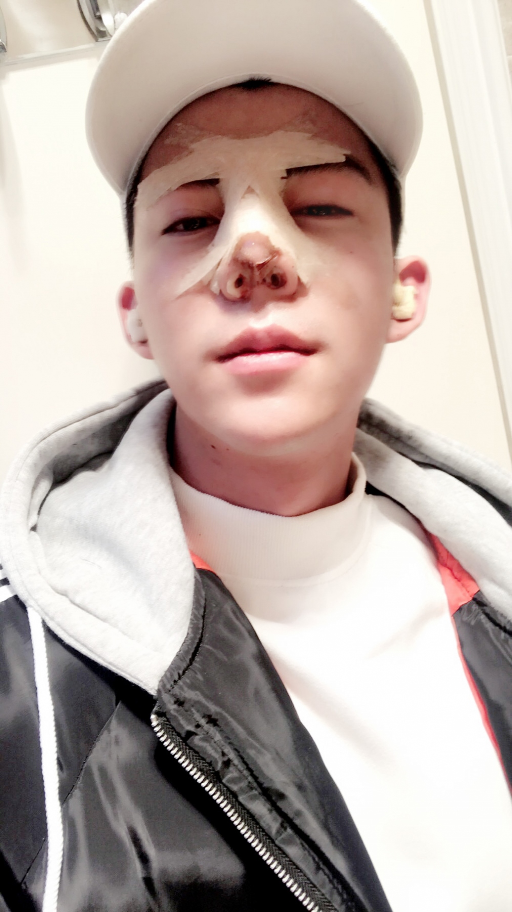 濟(jì)寧名美醫(yī)療整形醫(yī)生李唯少假體隆鼻+耳軟骨墊鼻尖真實案例效果對比圖 濟(jì)寧名美醫(yī)療整形醫(yī)生李唯少假體隆鼻+耳軟骨墊鼻尖真實案例效果對比圖