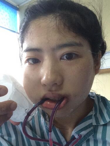 下頜角手術(shù)第二天 下頜角手術(shù)第二天