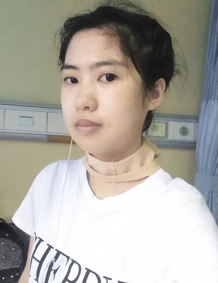 下頜角手術(shù)第八天 下頜角手術(shù)第八天