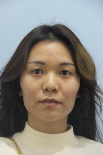 長(zhǎng)沙星雅醫(yī)療美容醫(yī)院做埋線提升去法令紋效果怎么樣？附金振玉醫(yī)生案例