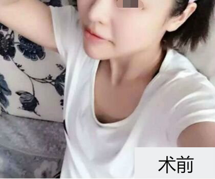 深圳博美整形醫(yī)生劉超做自體脂肪隆胸怎么樣？自體脂肪隆胸案例