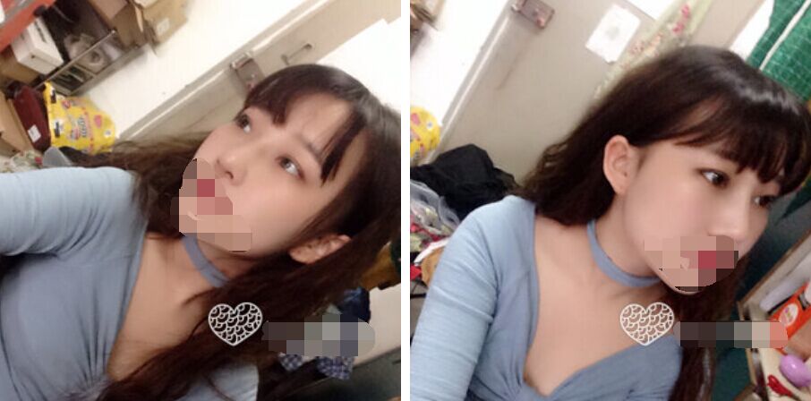 珠海艾瑞醫(yī)療美容醫(yī)院余昌盛醫(yī)生做耳軟骨隆鼻真實案例分享 珠海艾瑞醫(yī)療美容醫(yī)院余昌盛醫(yī)生做耳軟骨隆鼻真實案例分享