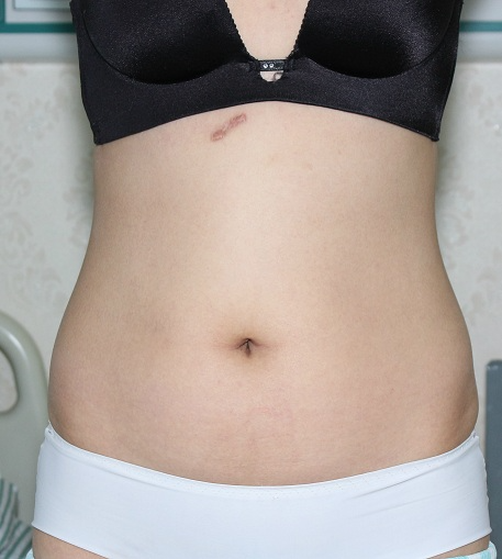 深圳晨曦整形醫(yī)院吉米斯做腰腹吸脂怎么樣？附吉米斯醫(yī)生腰腹吸脂案例