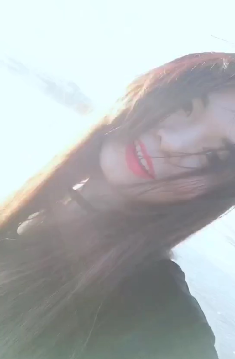 埋線提升去法令紋效果圖