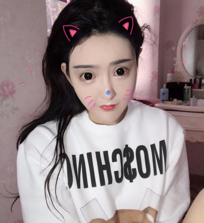 重慶柏漫醫(yī)療美容診所高紅艷醫(yī)生做面部吸脂怎么樣？面部吸脂案例分享