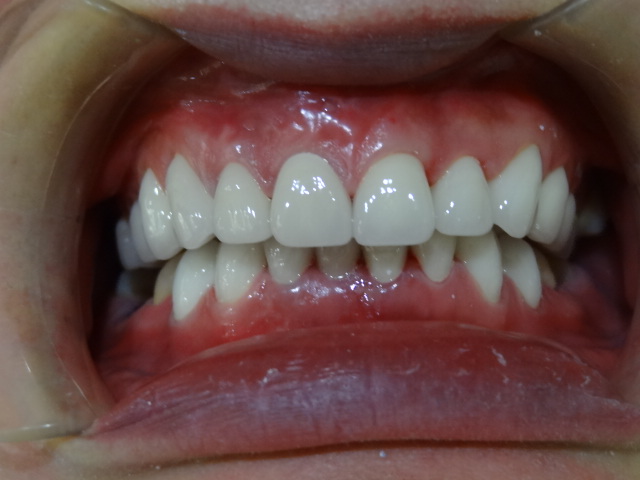 超聲波洗牙第七天