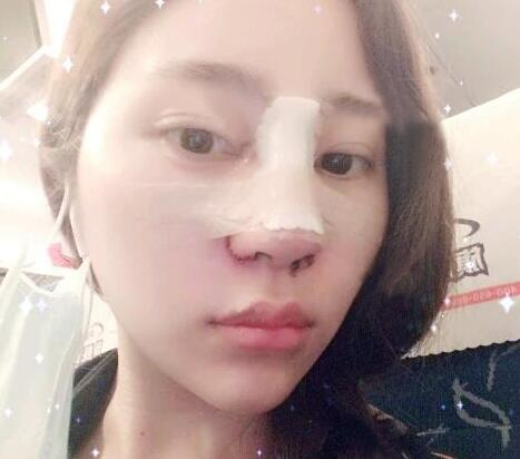 蘇州明基醫(yī)院醫(yī)療美容科做鼻綜合整形怎么樣？蘇州明基鼻綜合整形案例