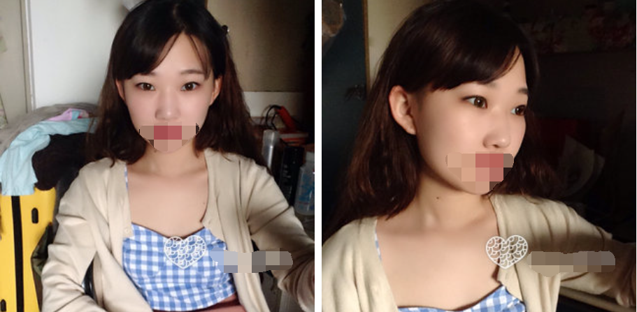 珠海艾瑞醫(yī)療美容醫(yī)院余昌盛醫(yī)生做耳軟骨隆鼻真實案例分享 珠海艾瑞醫(yī)療美容醫(yī)院余昌盛醫(yī)生做耳軟骨隆鼻真實案例分享