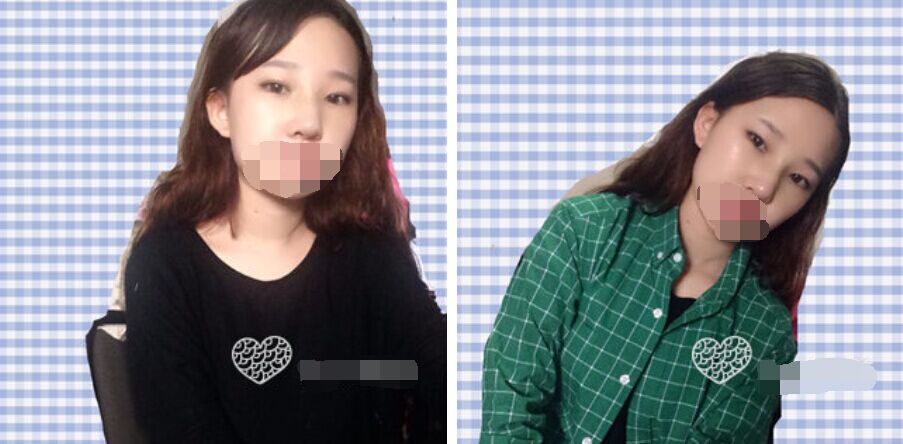 珠海艾瑞醫(yī)療美容醫(yī)院余昌盛醫(yī)生做耳軟骨隆鼻真實案例分享 珠海艾瑞醫(yī)療美容醫(yī)院余昌盛醫(yī)生做耳軟骨隆鼻真實案例分享