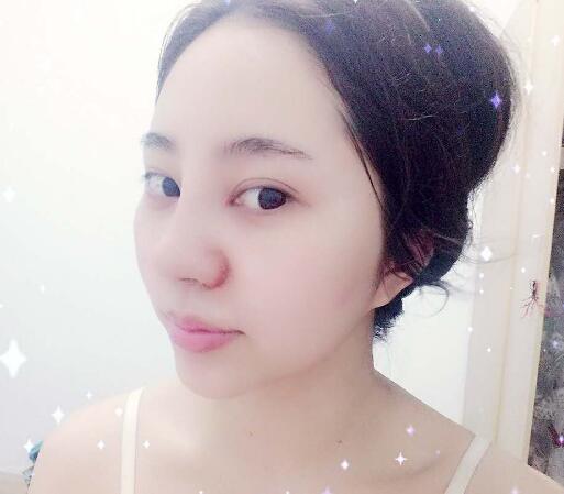 蘇州明基醫(yī)院醫(yī)療美容科做鼻綜合整形怎么樣？蘇州明基鼻綜合整形案例