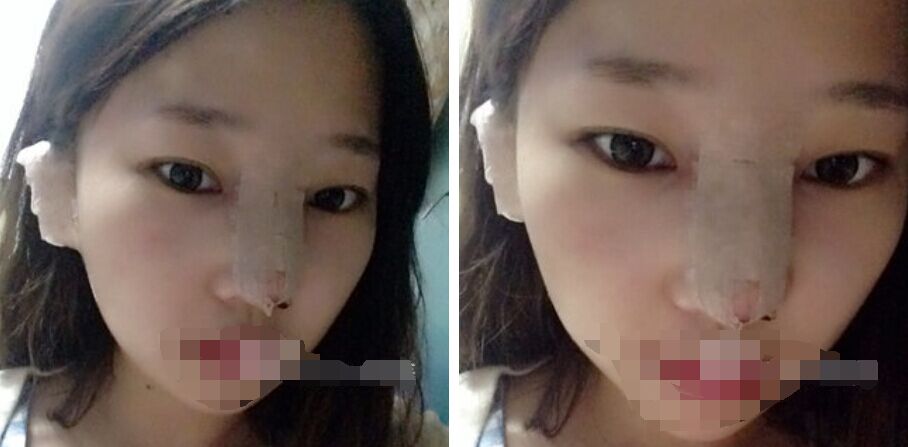 珠海艾瑞醫(yī)療美容醫(yī)院余昌盛醫(yī)生做耳軟骨隆鼻真實案例分享 珠海艾瑞醫(yī)療美容醫(yī)院余昌盛醫(yī)生做耳軟骨隆鼻真實案例分享