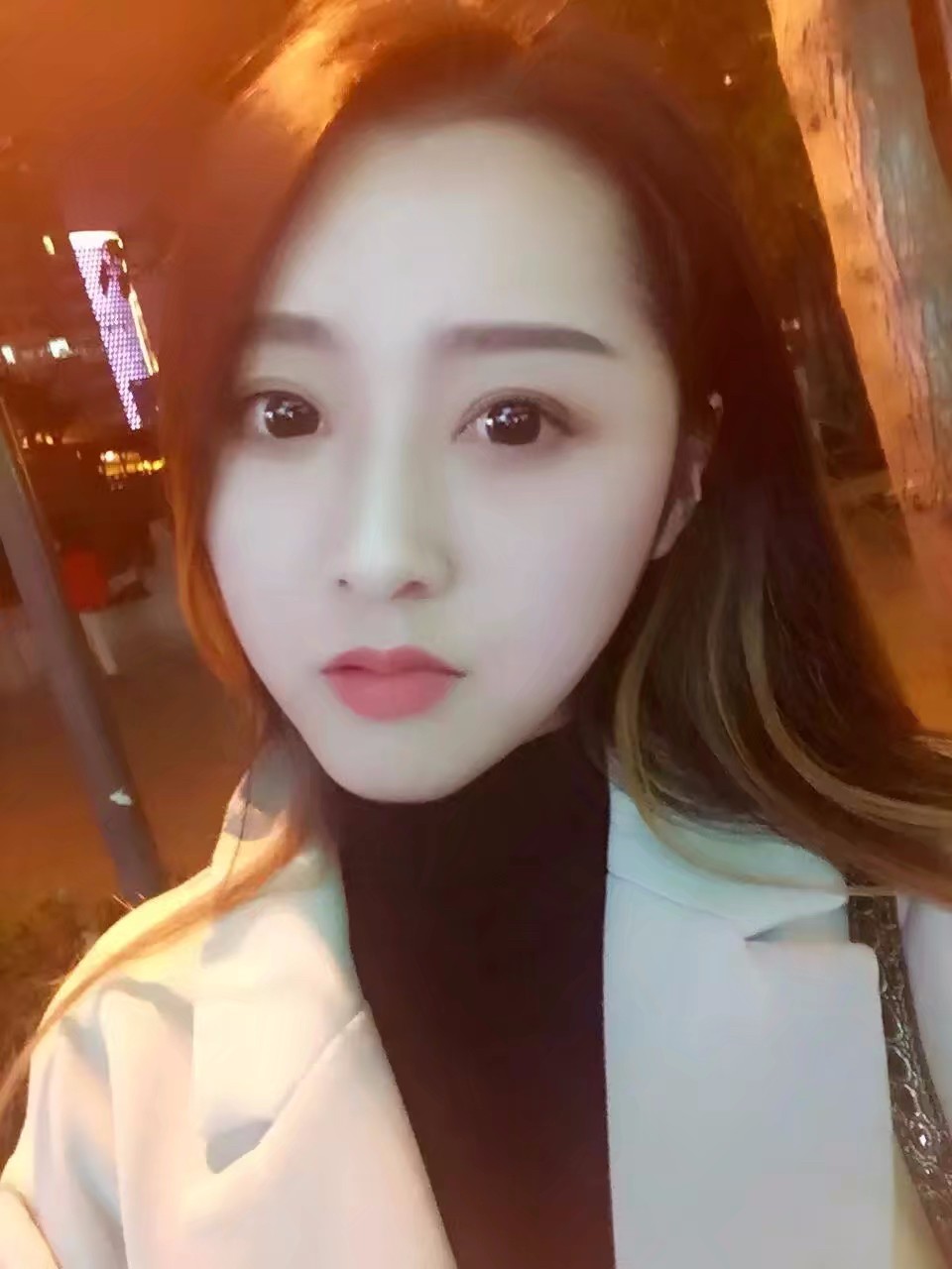 西安米蘭柏羽整形醫(yī)院李旭平做切開雙眼皮效果怎么樣？附案例