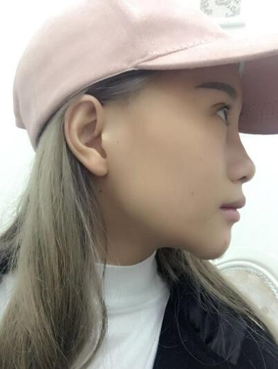 長春奧拉克美容醫(yī)院金相勛醫(yī)生做玻尿酸豐臥蠶怎么樣？附案例