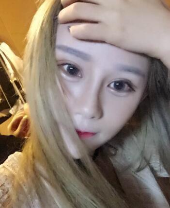 長春奧拉克美容醫(yī)院金相勛醫(yī)生做玻尿酸豐臥蠶怎么樣？附案例