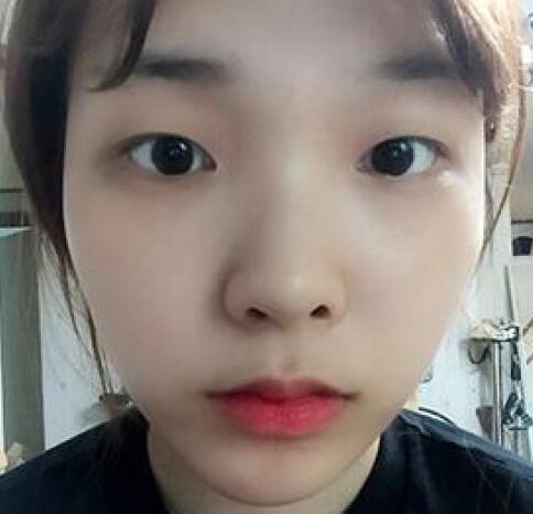 象山華美整形美容醫(yī)院趙誠(chéng)厚醫(yī)生做切開(kāi)雙眼皮+開(kāi)內(nèi)眼角整形案例