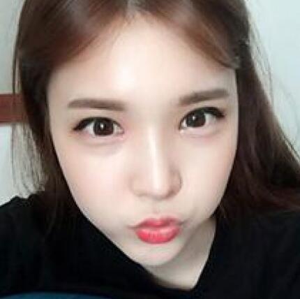 象山華美整形美容醫(yī)院趙誠(chéng)厚醫(yī)生做切開(kāi)雙眼皮+開(kāi)內(nèi)眼角整形案例