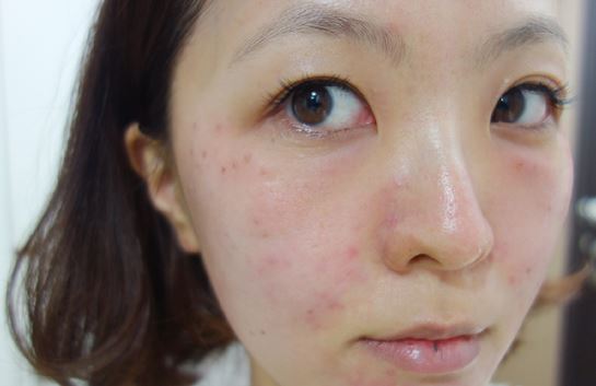 徐州時光洪揚醫(yī)療美容診所宮昔愿醫(yī)生做激光祛斑效果怎么樣？