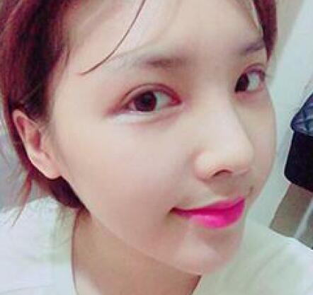 象山華美整形美容醫(yī)院趙誠(chéng)厚醫(yī)生做切開(kāi)雙眼皮+開(kāi)內(nèi)眼角整形案例