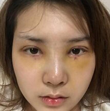 象山華美整形美容醫(yī)院趙誠(chéng)厚醫(yī)生做切開(kāi)雙眼皮+開(kāi)內(nèi)眼角整形案例