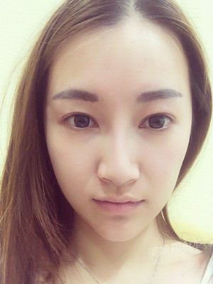 重慶五洲女子醫(yī)院整形美容中心做光子嫩膚怎么樣？淡明斌醫(yī)生光子嫩膚案例