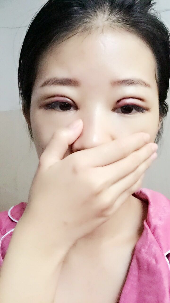 深圳晨曦醫(yī)療整形醫(yī)生吉米斯做切開雙眼皮怎么樣？吉米斯切開雙眼皮案例效果