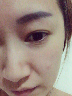 重慶五洲女子醫(yī)院整形美容中心做光子嫩膚怎么樣？淡明斌醫(yī)生光子嫩膚案例