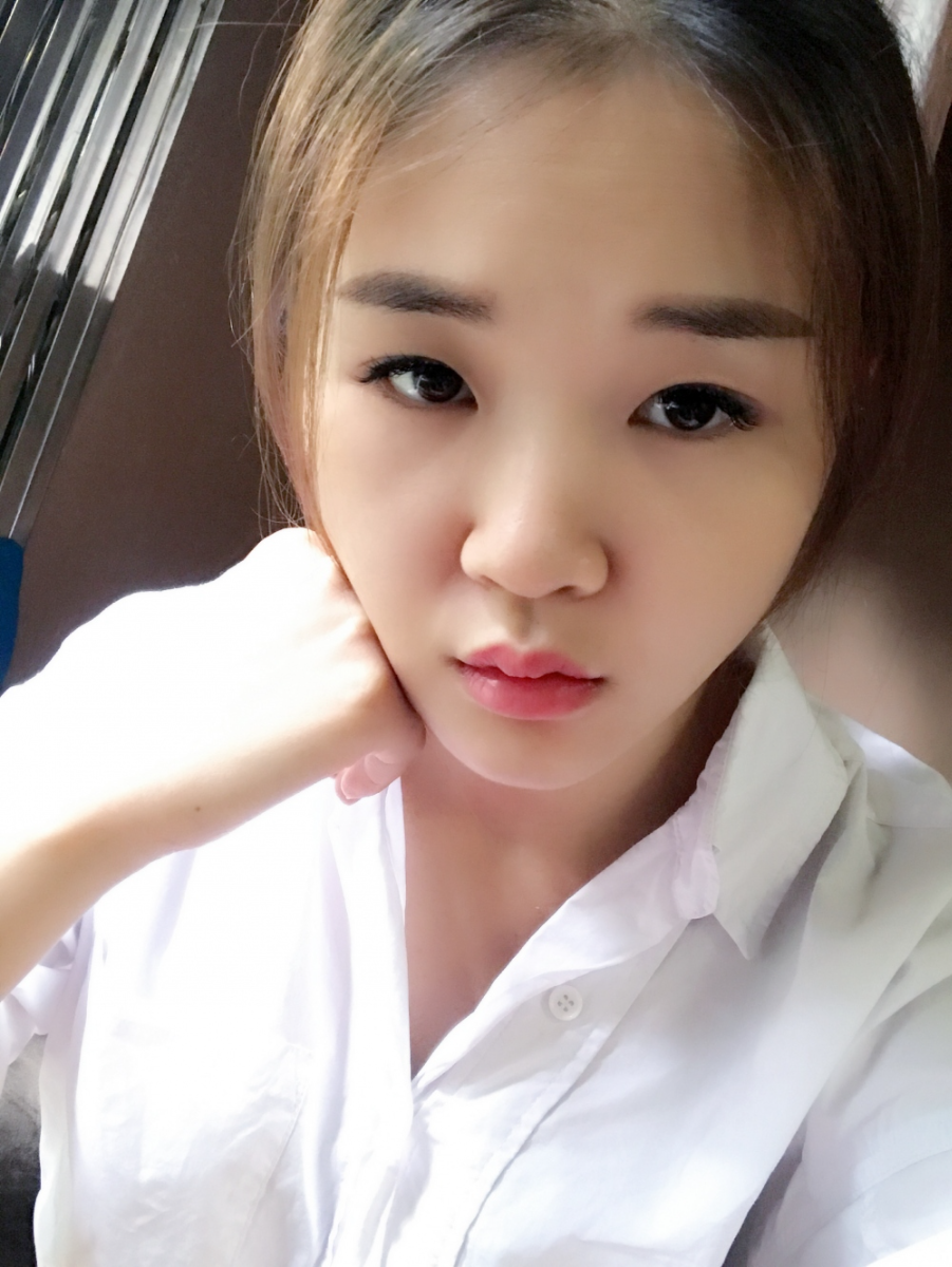 鄭州華領醫(yī)療美容醫(yī)院賀小虎醫(yī)生做眼綜合+鼻部整形手術效果怎么樣？