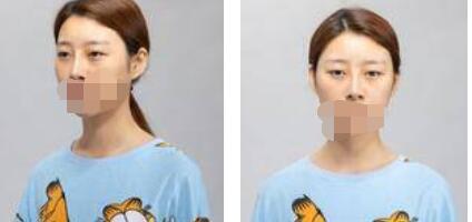 太原歐美蓮整形醫(yī)院丁曉峰醫(yī)生做雙眼皮怎么樣？丁曉峰雙眼皮手術(shù)案例分享