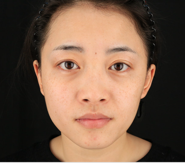 重慶當(dāng)代整形李敏旭醫(yī)生做皮秒激光祛斑效果怎么樣？附皮秒激光祛斑案例