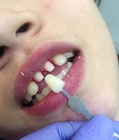 武漢康承貝健口腔醫(yī)院宋磊醫(yī)生做二氧化鋯全瓷牙效果怎么樣？附案例