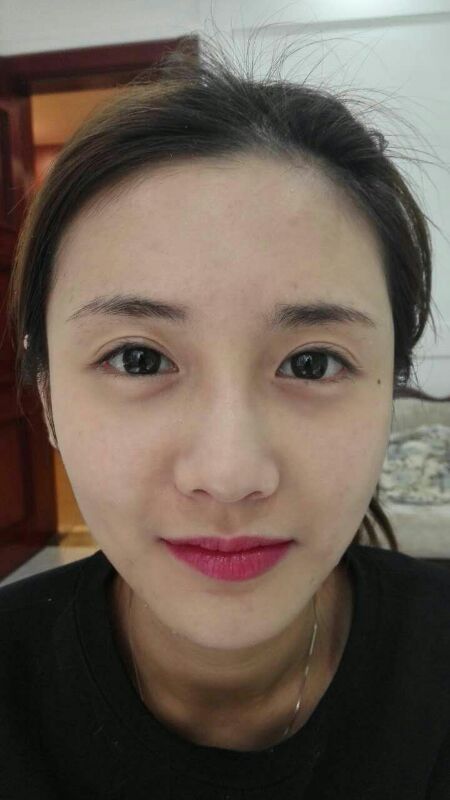 鄭州銘藝整形醫(yī)生陳濤做切開雙眼皮怎么樣？鄭州銘藝切開雙眼皮案例