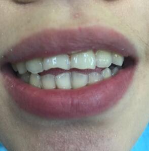 武漢康承貝健口腔醫(yī)院宋磊醫(yī)生做二氧化鋯全瓷牙效果怎么樣？附案例
